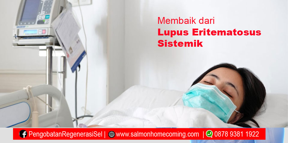 Obat Penyakit Lupus Eritematosus Sistemik